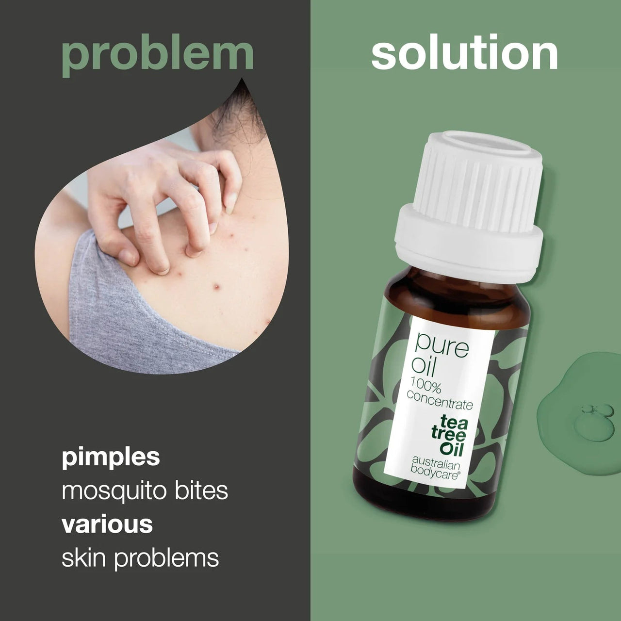 Australian Bodycare Pure Tea Tree Oil - 100% Concentrated & Natural (10ml) - liquidation.store